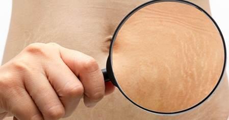 Hidratação da pele ajuda a prevenir e melhorar estrias?