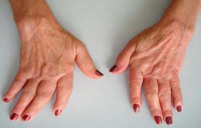 Como diagnosticar a artrite reumatoide