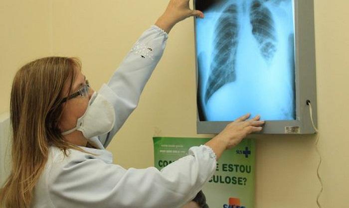 Pneumologista alerta para prevenção da tuberculose