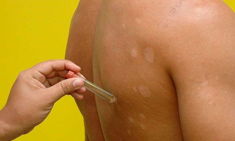 Teste inédito pode ajudar eliminação da hanseníase